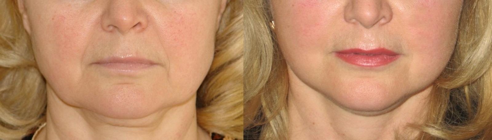 Before and after case: Plastic surgery, photo 1