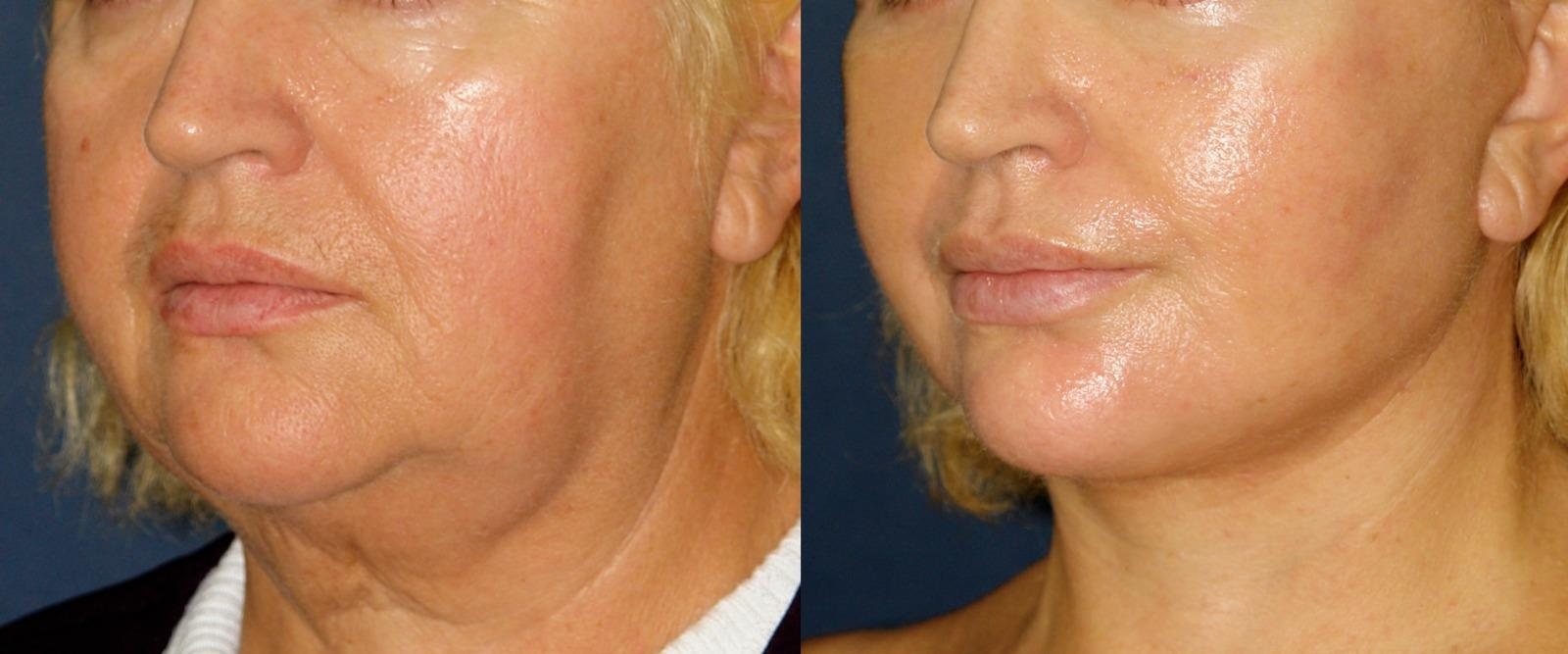 Before and after case: Plastic surgery, photo 2
